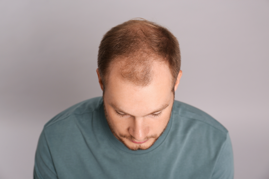 Alopecia – Factori De Risc, Cauze și Tratament. De Ce Chelesc Bărbații