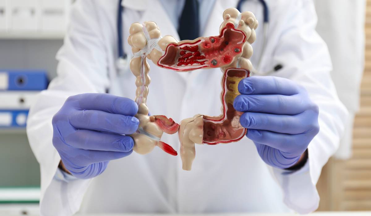 Alimentul care reduce riscul de cancer de colon. Descoperirea surprinzătoare a cercetătorilor