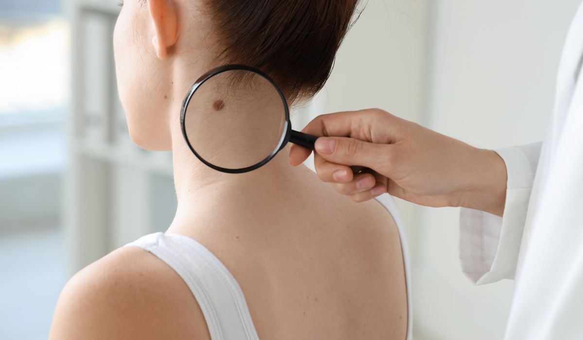 Ai o aluniță care ți se pare ciudată? Peste 400 de români pot afla gratuit dacă au risc de cancer de piele Ai o aluniță care ți se pare ciudată? Peste 400 de români pot afla gratuit dacă au risc de cancer de piele